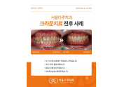 오래된 크라운 치료사례